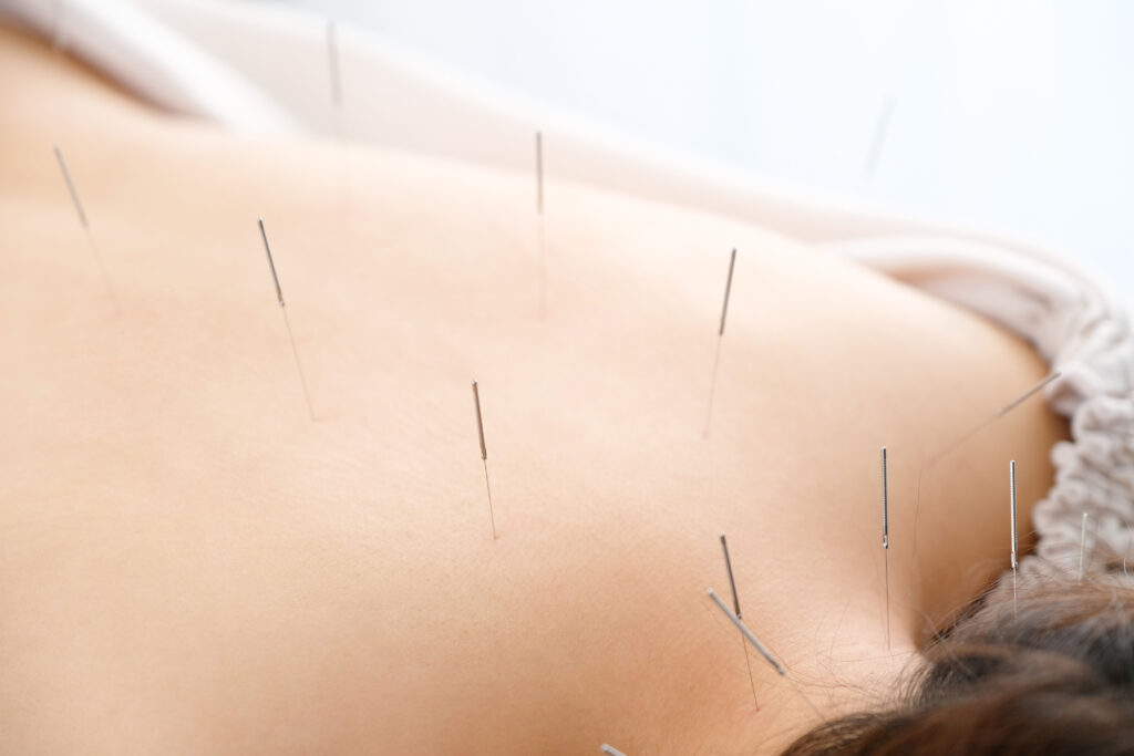 shutterstock 1636265428 1024x683 - Neck Pain Acupuncture at Biotherapy Clinic