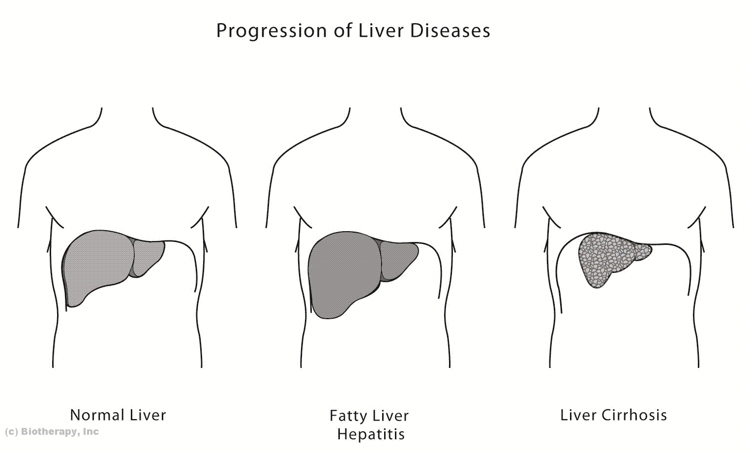 Biotherapy clinic. progression of liver disease