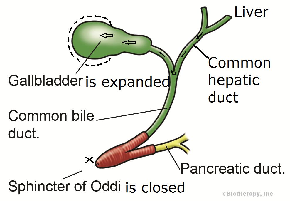 Acid reflux following gallbladder surgery