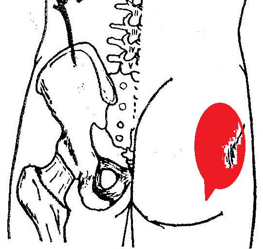 Pain in the buttock picture - Piriformis Syndrome (Buttock pain)