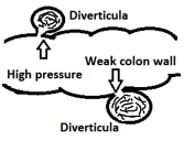 diverticulitis - Diverticulosis