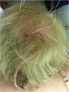Bold 2 226x300 - Hair loss and thinning