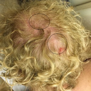 bold 1 300x300 - Hair loss and thinning