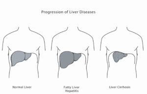 Picture3 300x193 - Liver Fibrosis and Cirrhosis