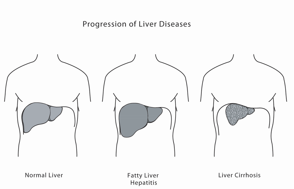 Liver Fibrosis and Cirrhosis