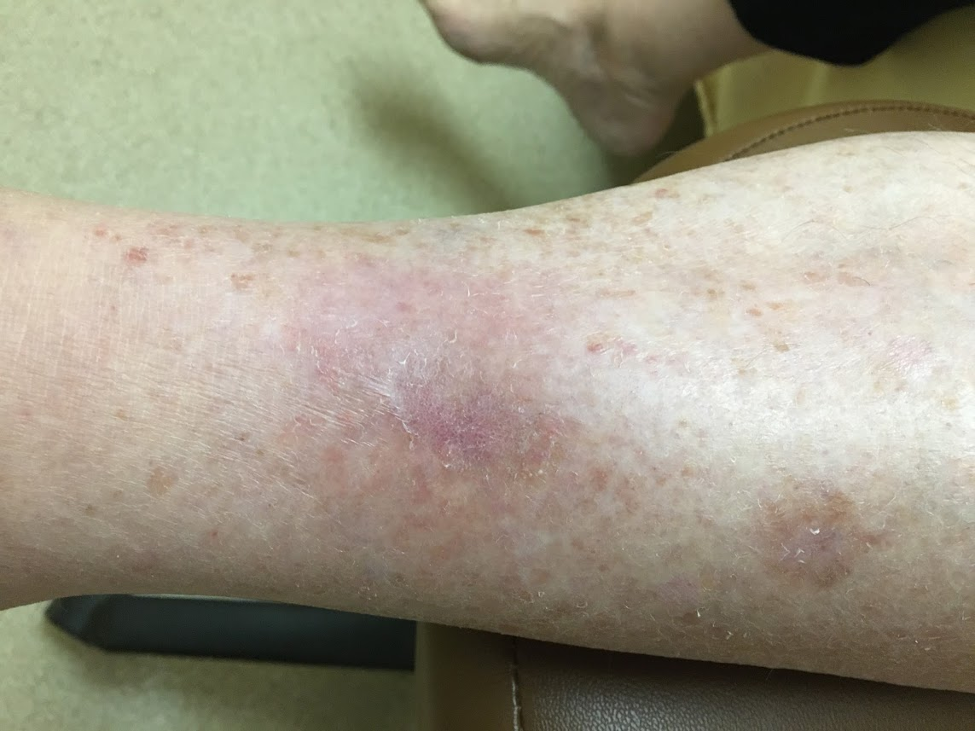 ulcers 3 - Lower Back Pain Acupuncture in San Francisco Bay Area